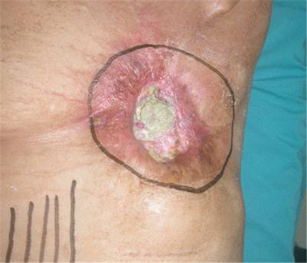 Vết loét do xạ trị